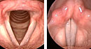 Normal Larynx